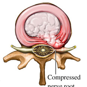 椎間板ヘルニア｜正常な椎間板とヘルニアが起こっている椎間板